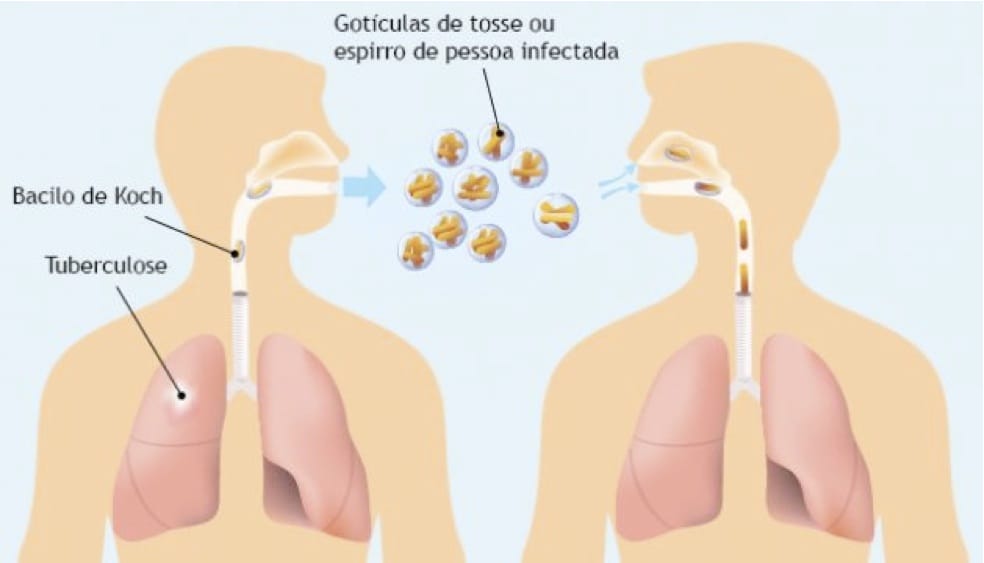 Focar de TBC la o școală din Roșiorii de Vede